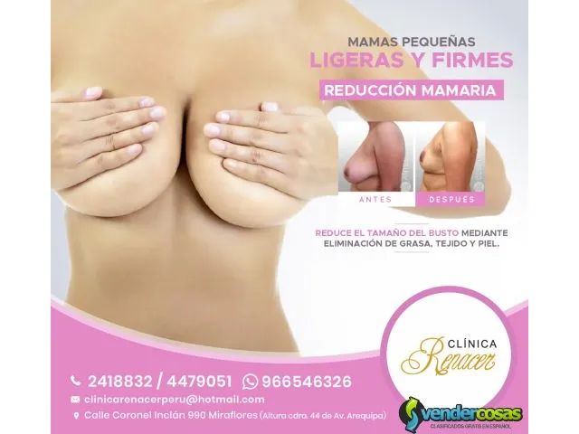 Cirugía de reducción de mamas - clínica renacer 1