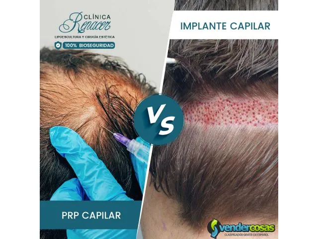 Implante capilar vs prp capilar. 1