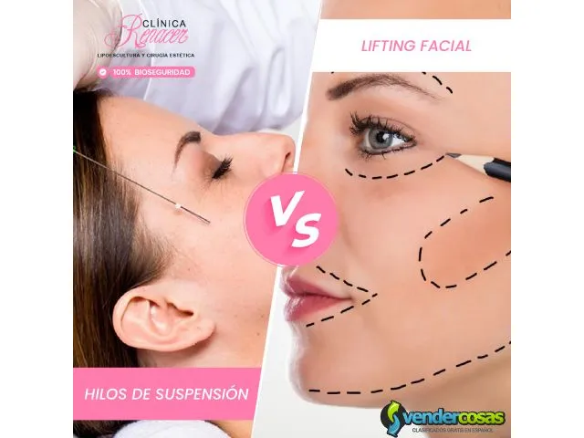 Lifting facial vs hilos de suspensión 1
