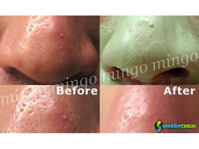 Mascarilla anti acne quita grasa del rostro  2