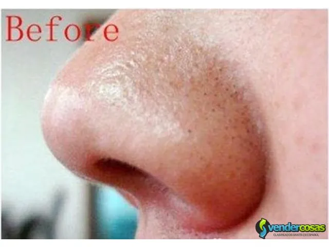 Mascarilla anti acne quita grasa del rostro  3