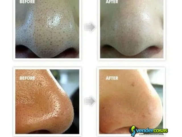 Mascarilla anti acne quita grasa del rostro  7