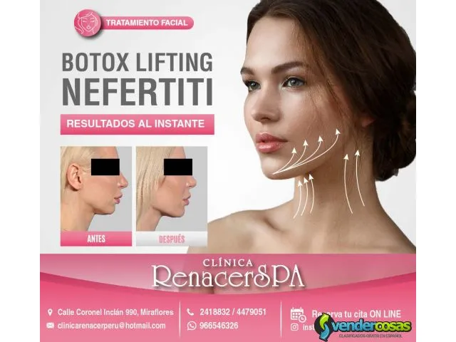 Nefertiti botox lift 1