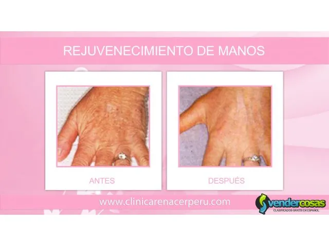 Rejuvenece la piel de las manos - clínica renacer 2