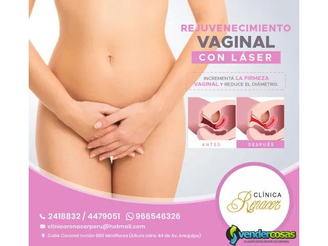 Tensado vaginal con láser - clínica renacer 1